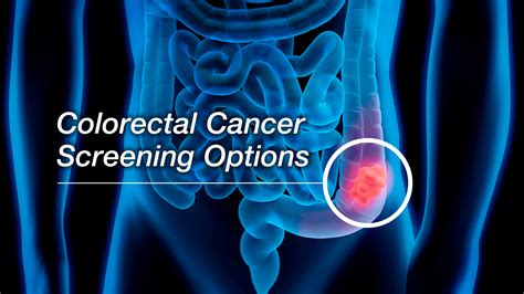 Colorectal Cancer What You Should Know About Screening Lingoexp