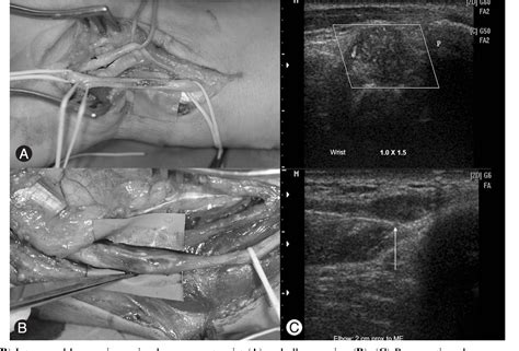 Figure 2 From Usefulness Of Ultrasonography In The Diagnosis Of Ulnar