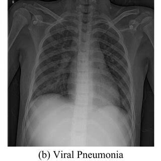 Examples Of Chest X Rays In ChestXRay2017 The Normal Viral Pneumonia