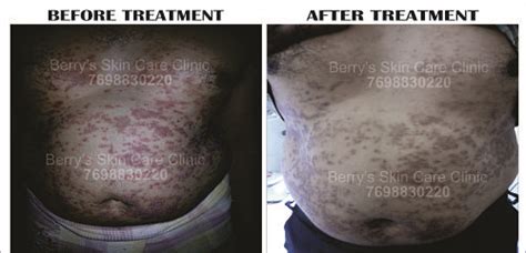 Chest Psoriasis Treatment Treatment For Chest Psoriasis Berry Skin Care