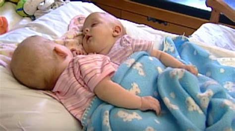 10 Years Ago These Conjoined Twins Were Separated What Do They Look Like Now Youtube