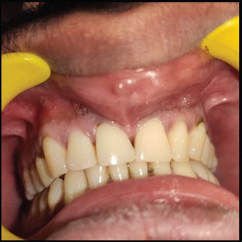 A And B Extraoral Swelling On The Left Mid Facial Region C