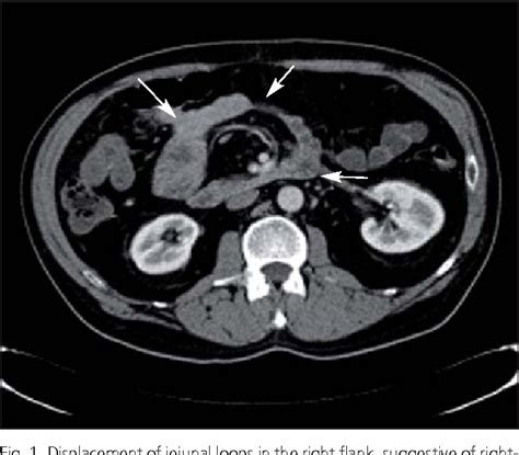 Figure 1 From Right Sided Paraduodenal Hernia Rare Cause Of Recurrent