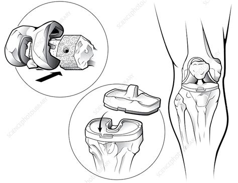Total Knee Replacement Prosthetic Stock Image C0221166 Science