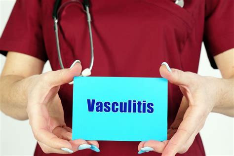 Vasculitis What It Is What The Symptoms Are And How To Treat It