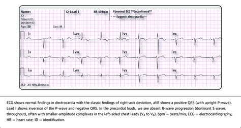 Left Sided Ecg Of A 50 Year Old Man With Dextrocardia Situs Inversus