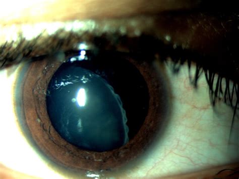 Figure Subluxated Crystalline Lens Ectopia Lentis Contributed By
