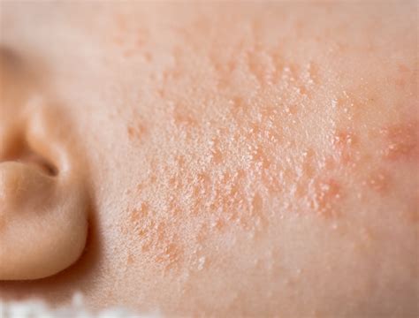 Difference Between Rosacea And Malar Rash Difference Between