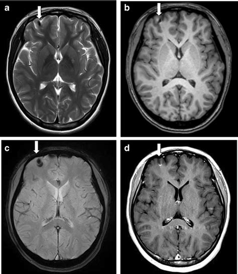 T2 Weighted Brain Magnetic Resonance Image Mri Showing A Hypointense
