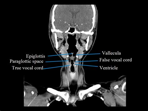 Nasopharynx Anatomy Ct Hot Sex Picture