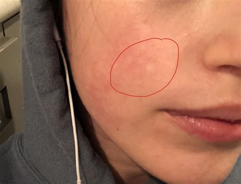 What Are These White Spots On My Cheek Just Noticed Them For The First