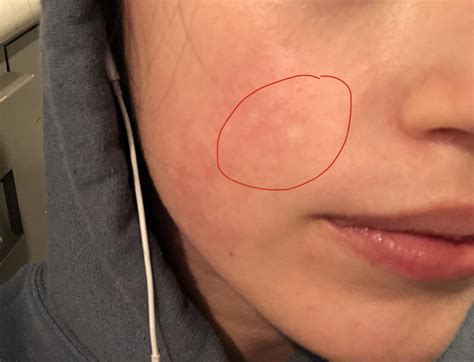 What Are These White Spots On My Face Advanced Dermat