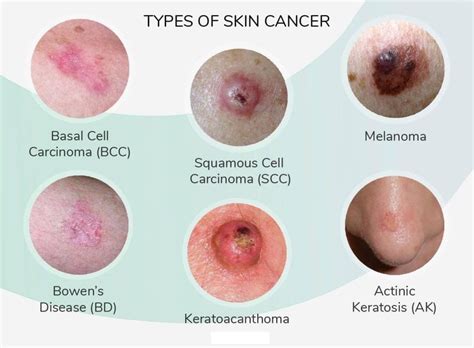 Know Early Signs Of Skin Cancer Drvijay Anand Reddy