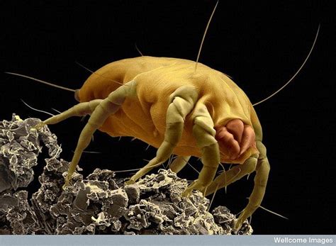 Atopic Childhood Eczema And Us Dust Mite Allergy Mites Spider Bites