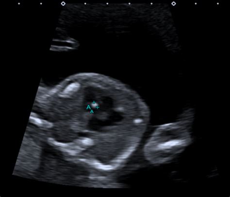 All About The 20 Week Pregnancy Ultrasound Erad Radiology