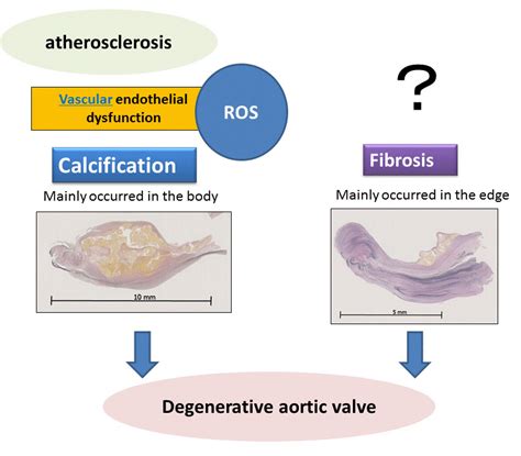 Dual Pathways Of Aortic Degenerative Change Calcification And Fibrosis