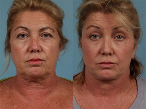 Faceliftminilift By Dr Mustoe Before And After Photo Gallery Chicago Il Tlkm Plastic Surgery