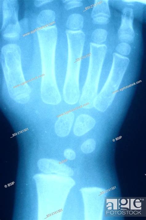 Wrist X Ray Result Normal Wrist Of A 4 Or 5 Year Old