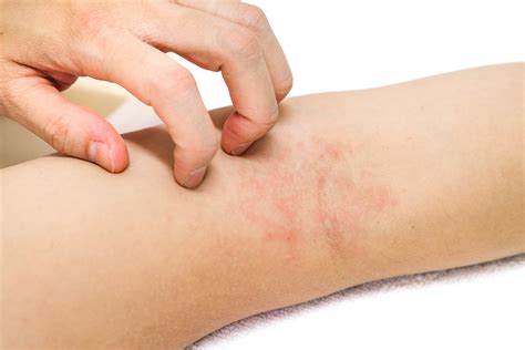 Dermatitis Rashes Eczema Ducharme Dermatology