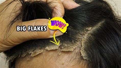 Plaque Psoriasis Removal Youtube Videos Psoriasis Flakes In Hair