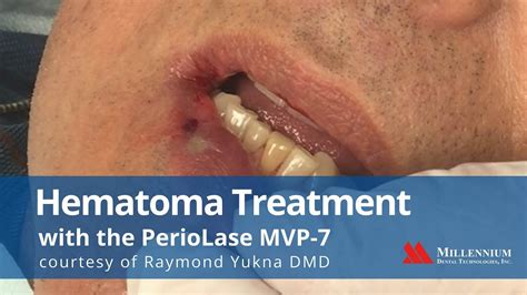 Hematoma Treatment With The Periolase Mvp 7 Youtube