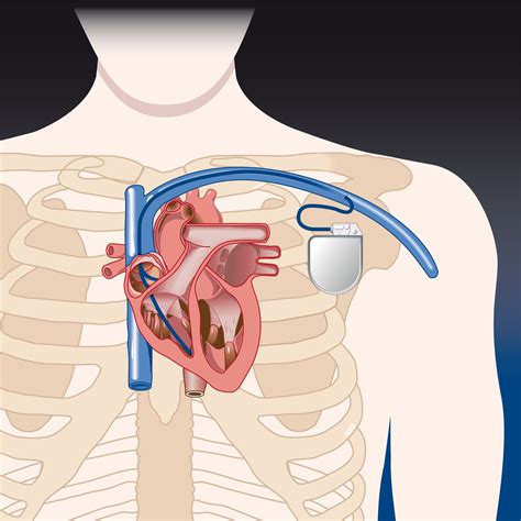 Pacemakers are often installed in people who are suffering from irregular heart rhythms. Pacemaker | Rythmo