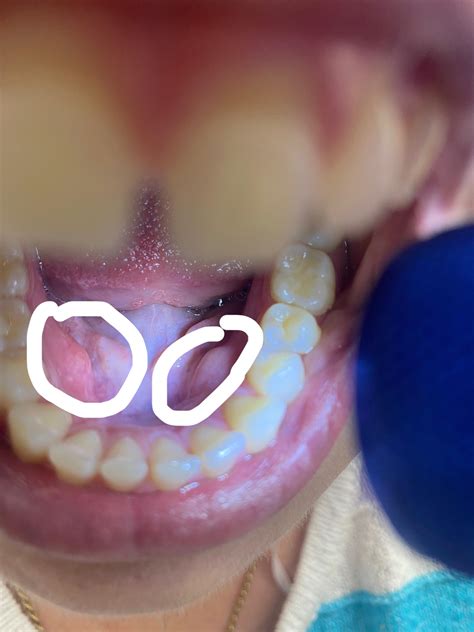 Hard lump? : r/Teethcare