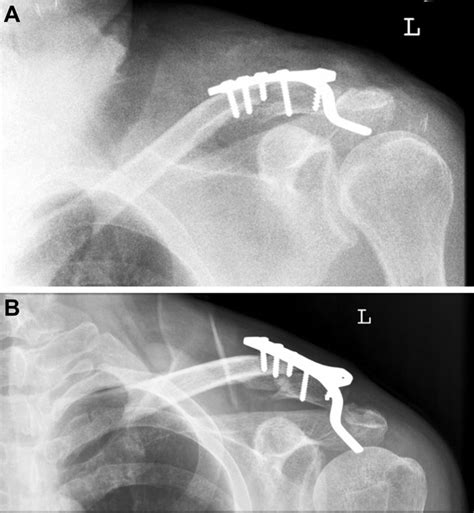 A 56 Year Old Man With Left Distal Clavicle Fracture Was Treated With