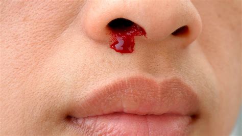 Scabs In Nose Causes Painful Bloody Treatment Home Remedies