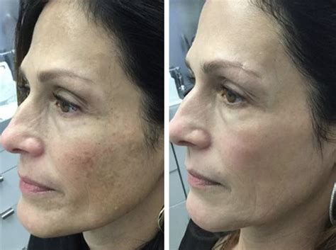 Before And After Pictures Of Fraxel Treatment Results Sobel Skin