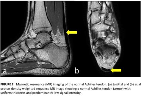 How Important Is Imaging For Tendon Pain And Injury — Mend
