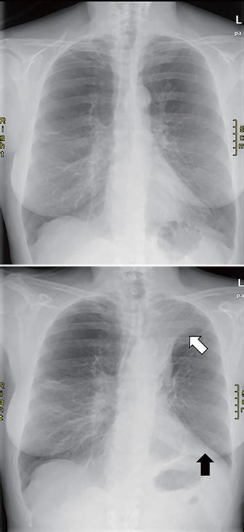 Role Of Chest Imaging In Bronchoscopic Lung Volume Reduction Using