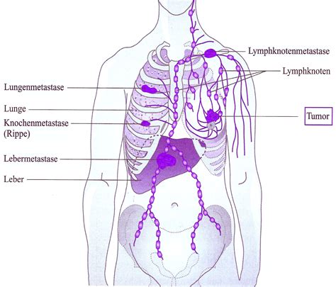 Brustkrebs Metastasen Brustkrebs Knochenmetastasen Brustkrebs Mammakarzinom