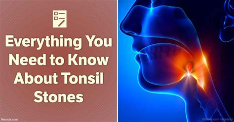 Everything You Need To Know About Tonsil Stones