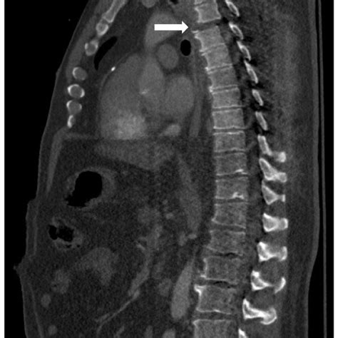 Pdf A Case Of A Traumatic Chyle Leak Following An Acute Thoracic