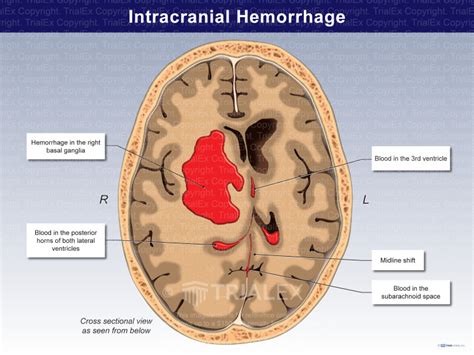 Intracranial Hemorrhage Trial Exhibits Inc
