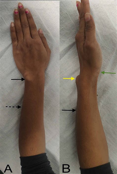Cureus Madelung Deformity Of The Wrist Managed Conservatively