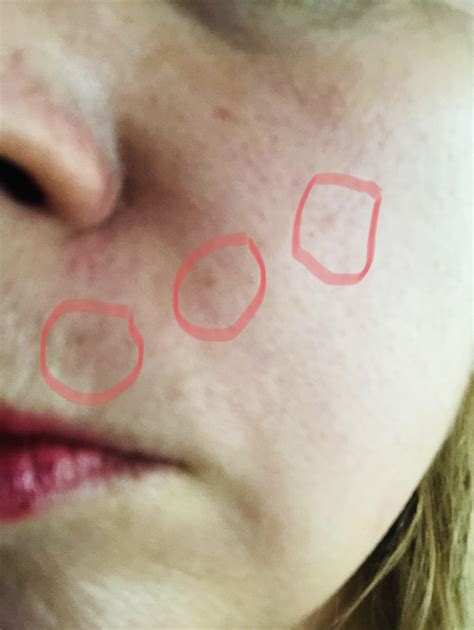 Bed Bug Bites On Face More Info In Comments Rbedbugs