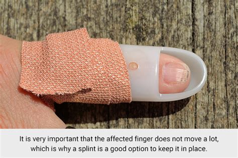 7 Natural Ways To Help Heal A Jammed Finger Emedihealth