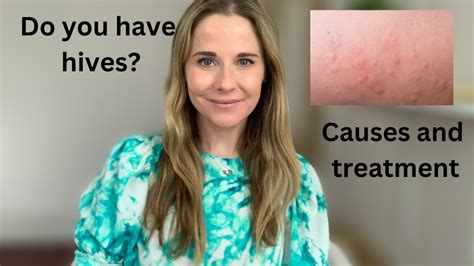 Hives Causes And Treatment Youtube