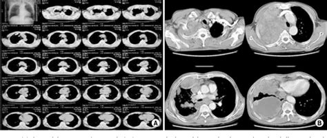 Figure 2 From A Case Of Advanced Malignant Pleural Mesothelioma