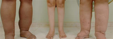 Elephantiasis Causes Symptoms And Treatment Bauerfeind Australia