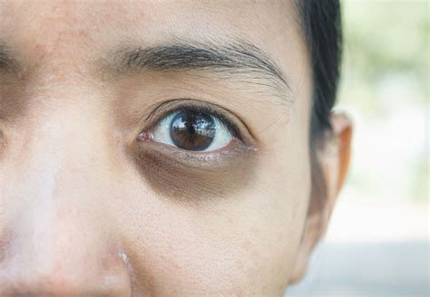 How To Get Rid Of Dark Eye Circles In Singapore
