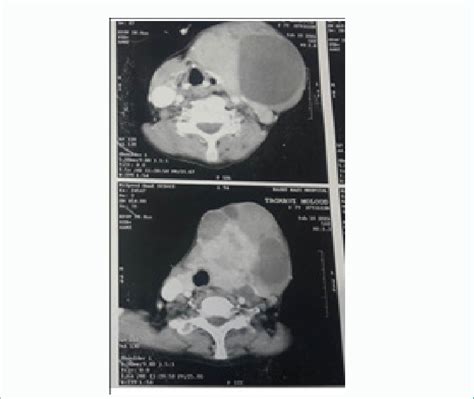 Show Ct Scan Of Patient With Huge Neck Cystic And Solid Mass Of Thyroid Download Scientific