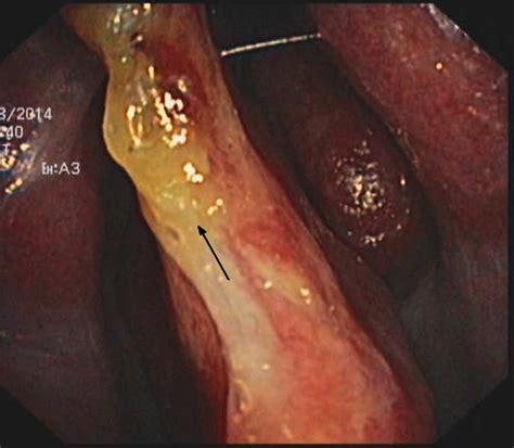 A deviated septum occurs when your nasal septum is significantly displaced to one side, making one nasal air passage smaller than the other. Perforation of the nasal septum