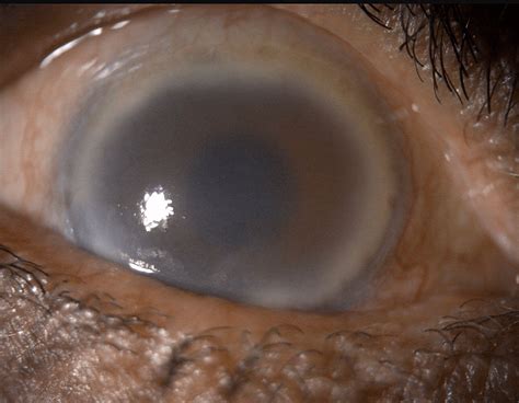 Cureus Haptic Amputation Under Endoscopic Guidance In Uveitis