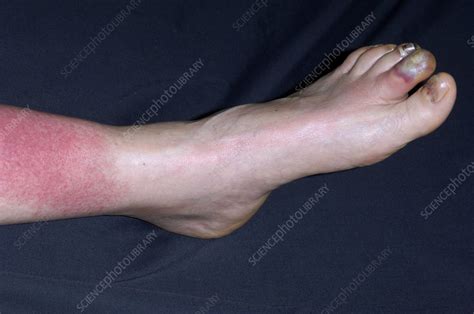 Lymphangitis Infection Of The Leg Stock Image M2000233 Science
