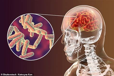 How Much Do You Know About Meningitis Daily Mail Online