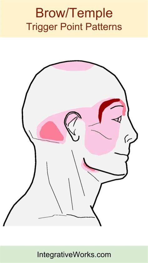 Headache In The Eyebrow Integrative Works Trigger Points Headache