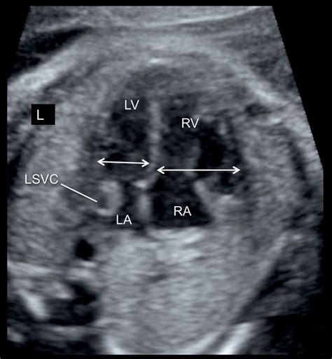 Coarctation Of The Aorta And Interrupted Aortic Arch Obgyn Key